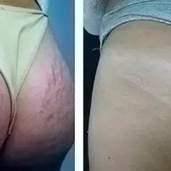 Stretch Marks treatment results