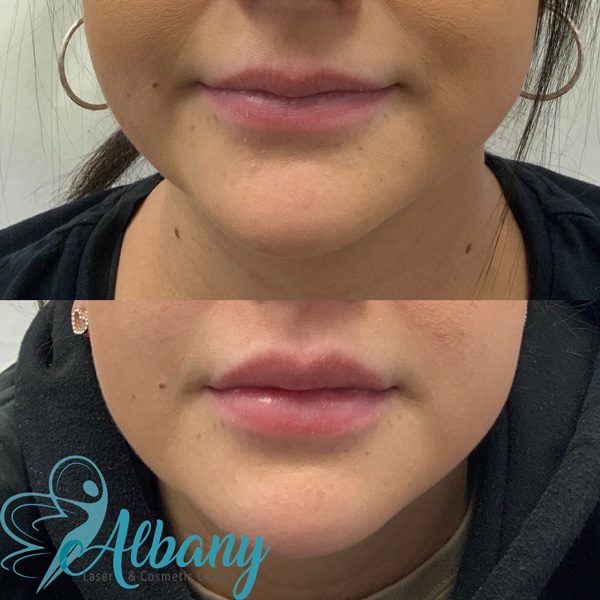 Before and after lip injections Edmonton