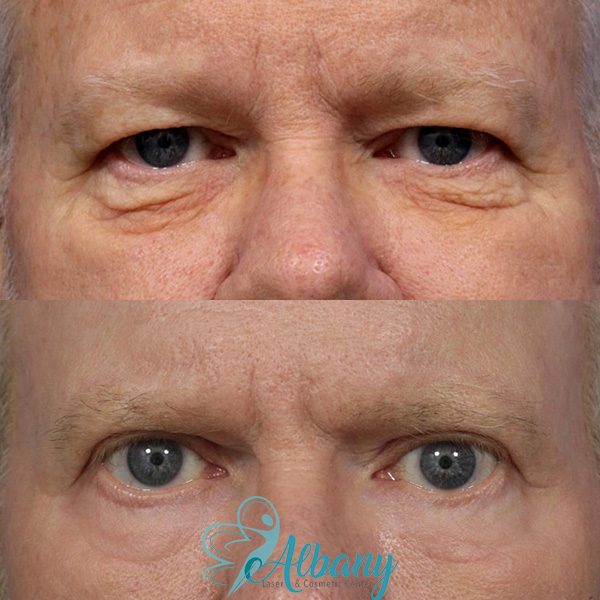 Before and after After eyelid lift