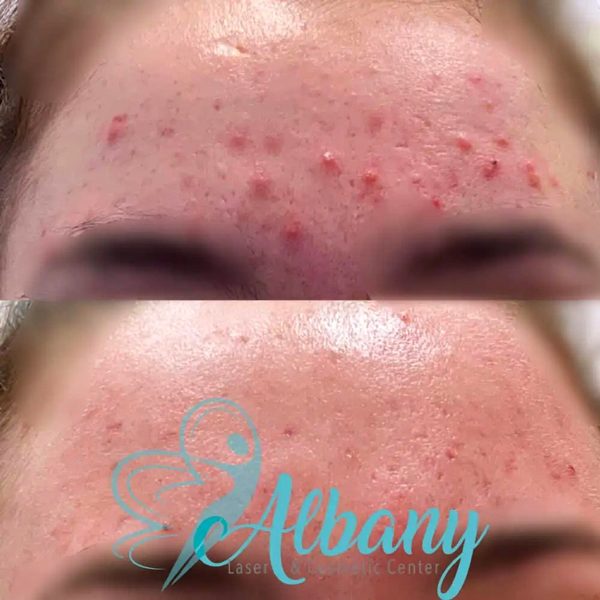 acne treatment results edmonton