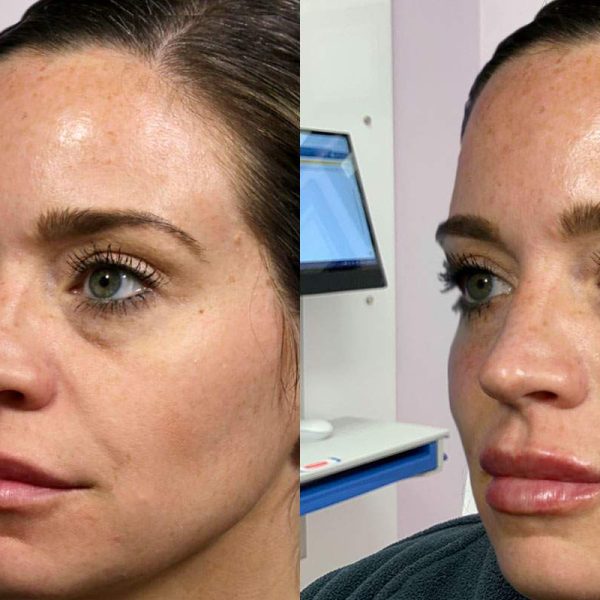 before and after cheek fillers