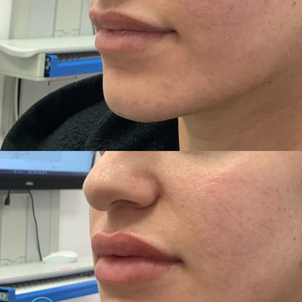 lip augmentation results