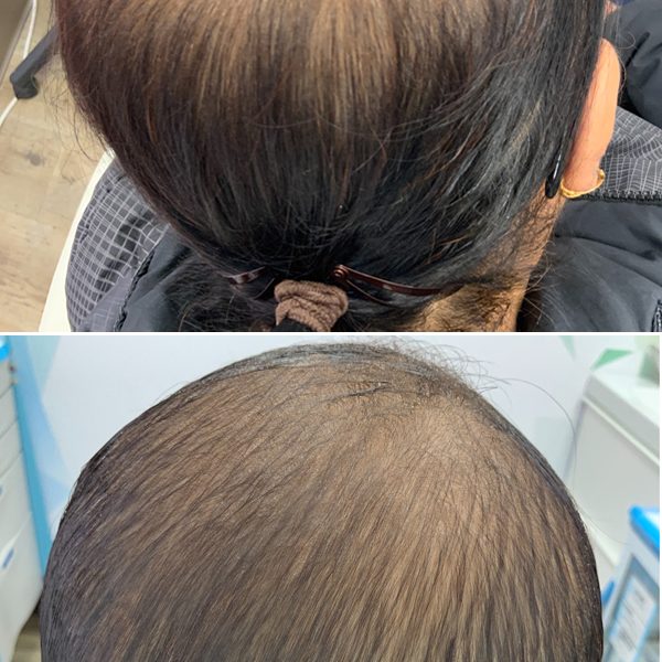 before and after hair restoration treatment edmonton