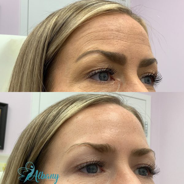 before and after Botox Treatment for forehead lines