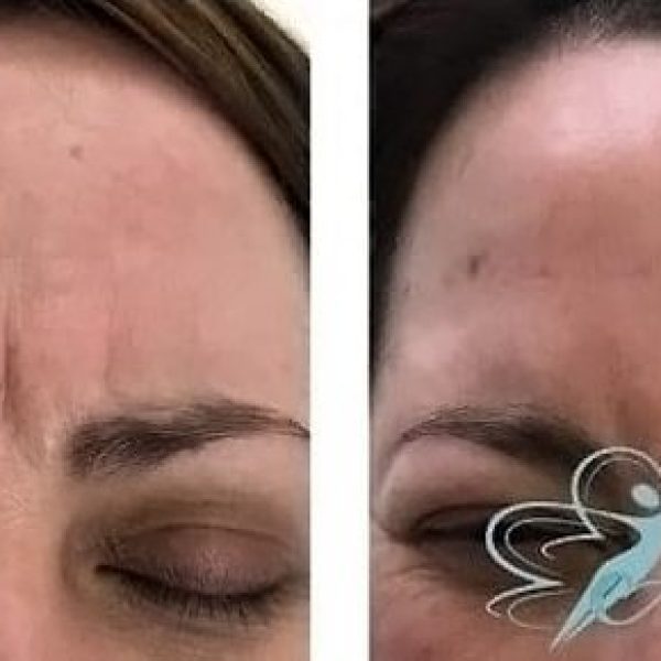 Botox results frownlines