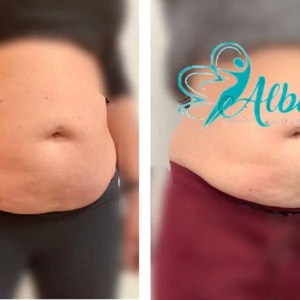 before and after coolsculpting results