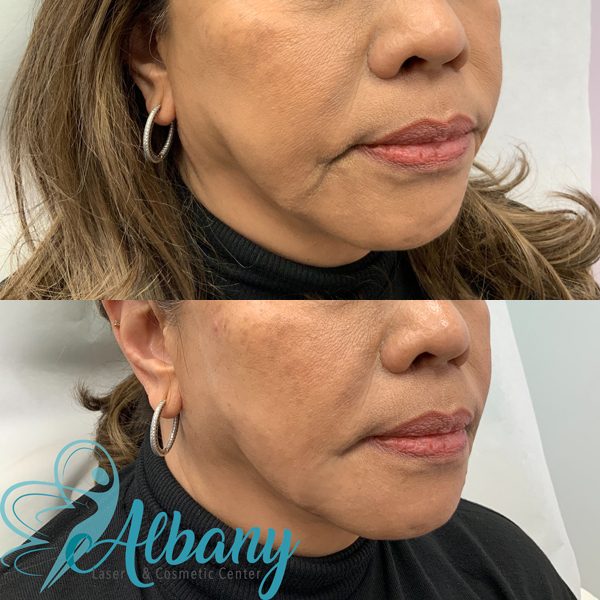 before and after fillers edmonton