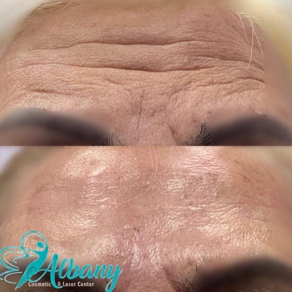 Botox Results forehead lines