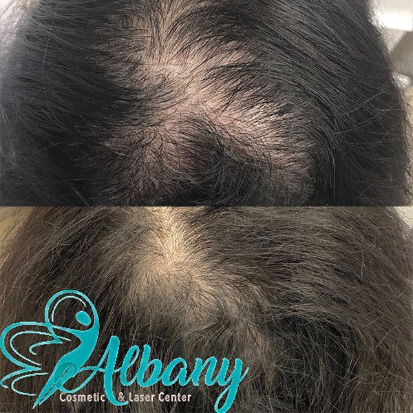 hair loss treatment results
