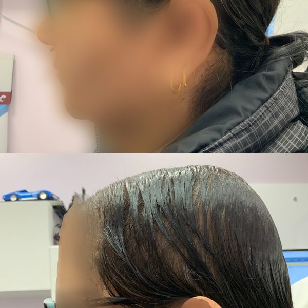 before and after hair loss treatment edmonton