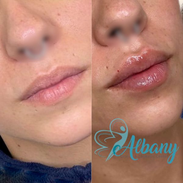 lip fillers results
