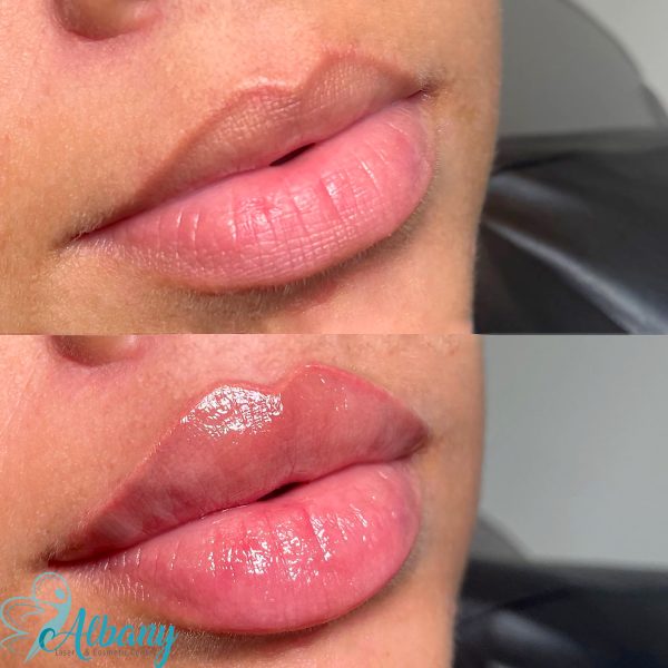 Lip fillers results