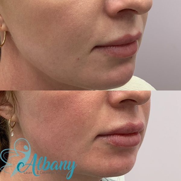 lip injections results edmonton
