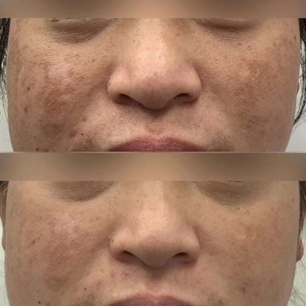 Close-Up Transformation: Melasma Treatment with Fraxel