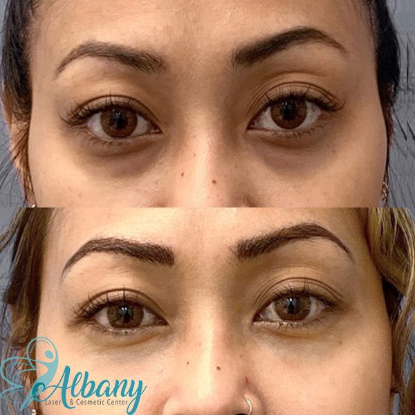 tear trough fillers results