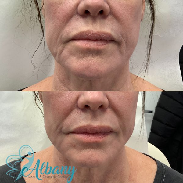 before ad after lower face lift