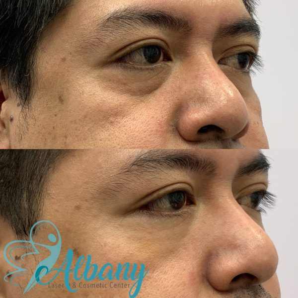 tear trough fillers results