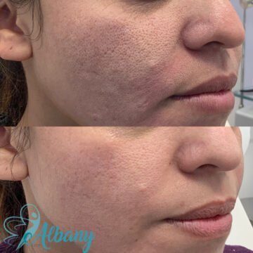enlarged pores treatment edmonton