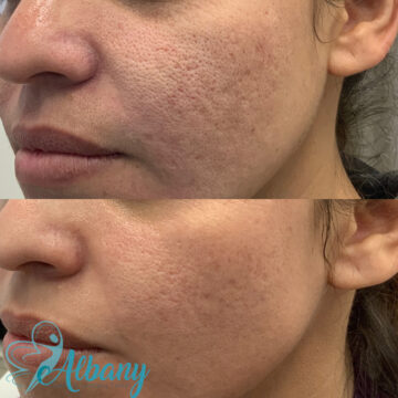 enlarged pores treatment