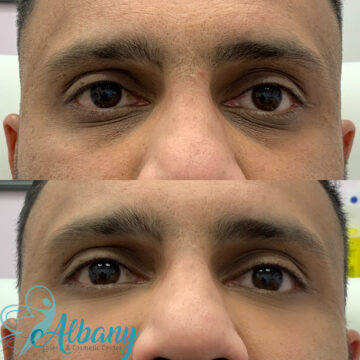 under eye fillers edmonton