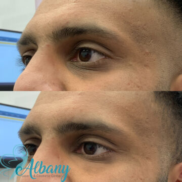 under eye fillers edmonton
