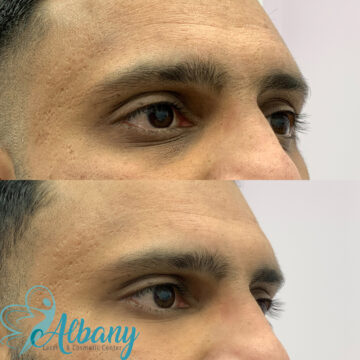 under eye fillers edmonton