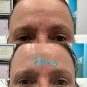 eyebrow lift results
