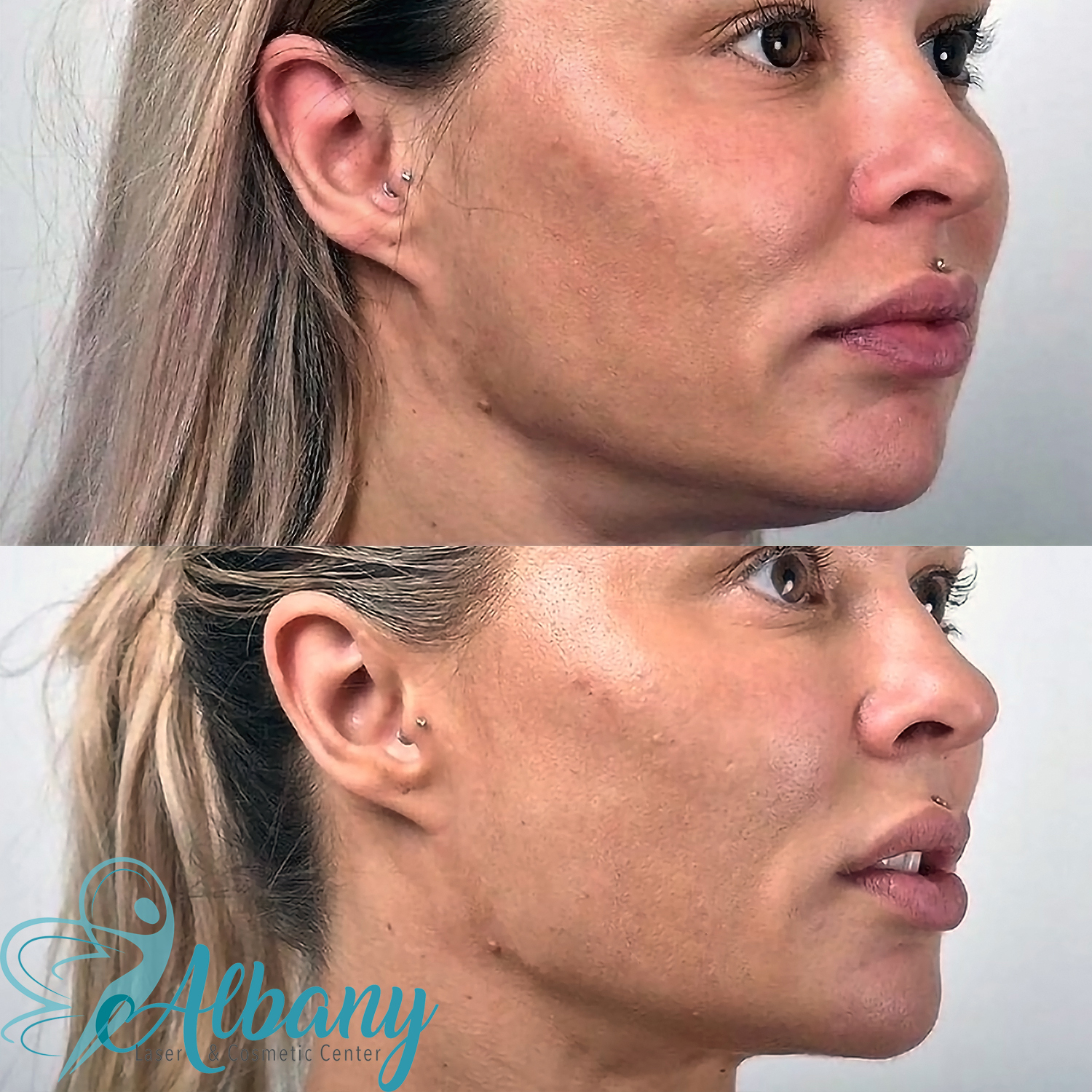 Facelift results in Edmonton