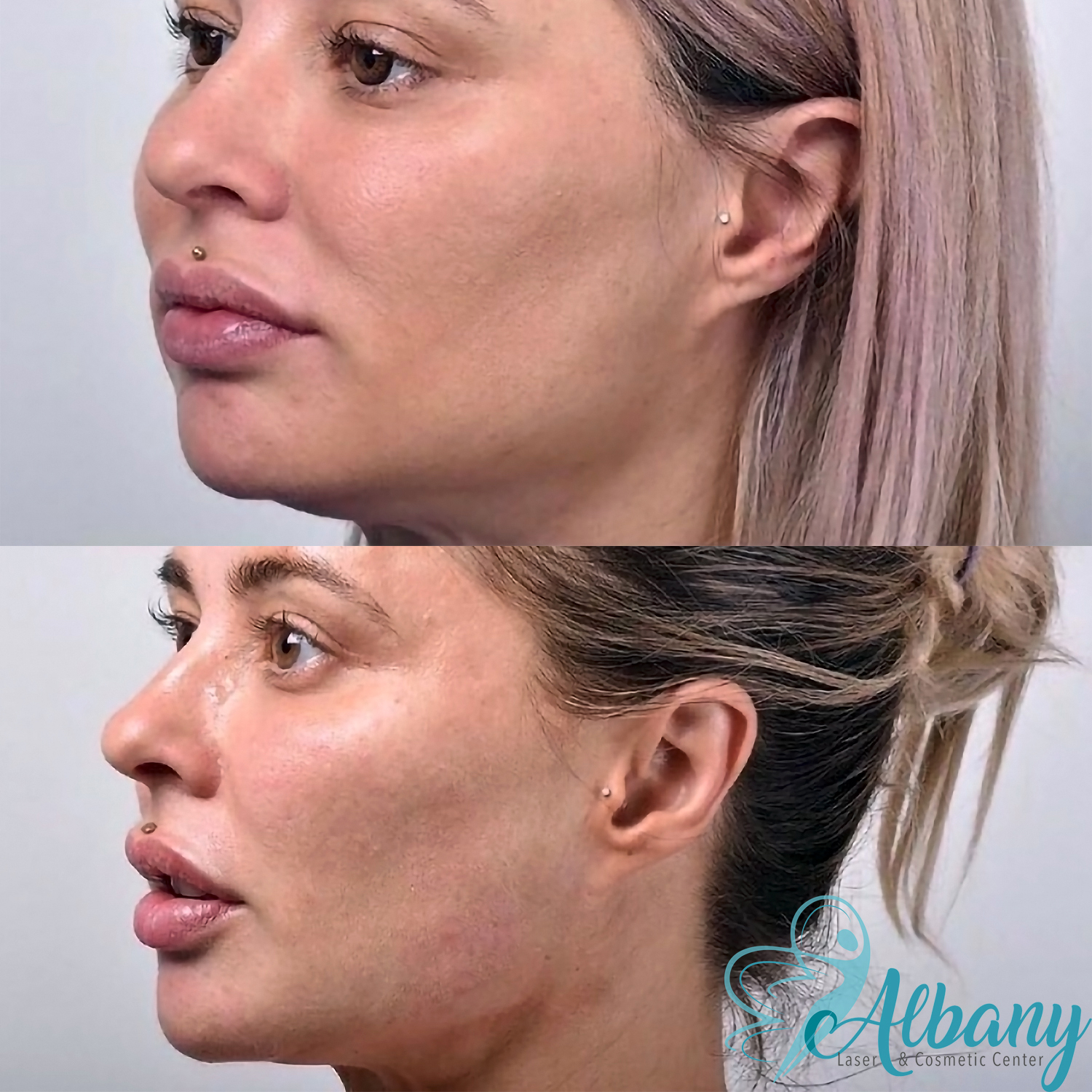 facelift results Edmonton