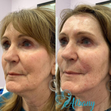 Before and after bellafill