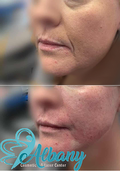 before and after mini facelift edmonton