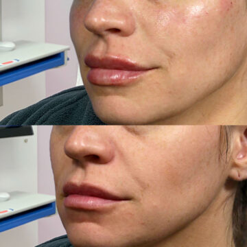 lip and cheek fillers