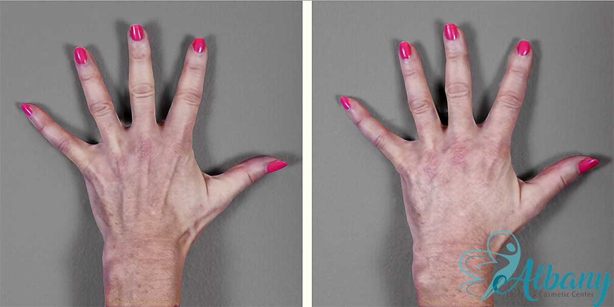 Hand wrinkles treatment