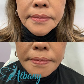 fillers injection edmonton