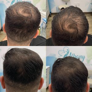 Four-panel crown/vertex scalp photos showing reduced scalp visibility and improved hair coverage in later photos compared with baseline