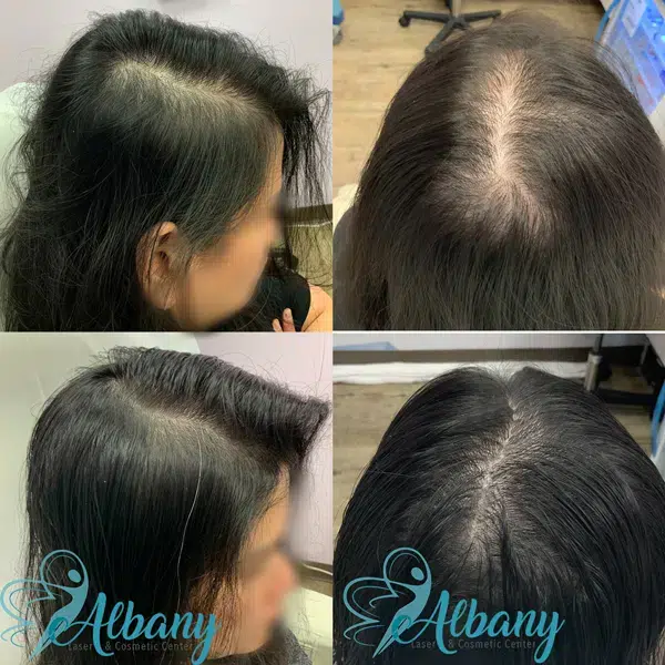 Comparison photos highlighting visible hair growth results from hair restoration treatments performed at Albany Cosmetic and Laser Centre.