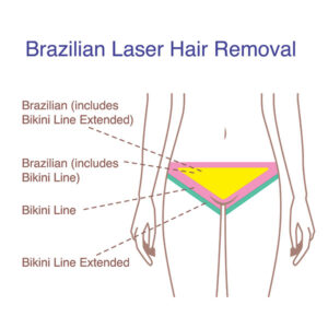 Bikini Laser hair removal