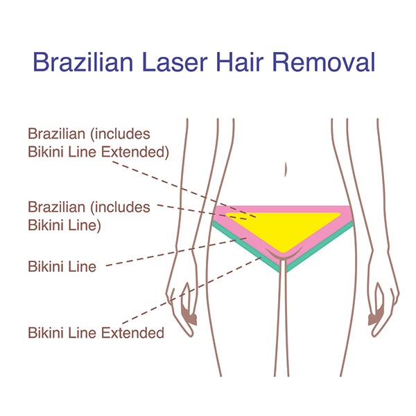 Bikini Laser hair removal