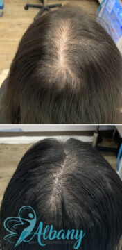 hair loss treatment results