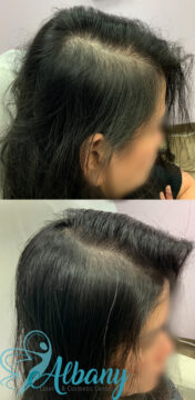 hair restoration results