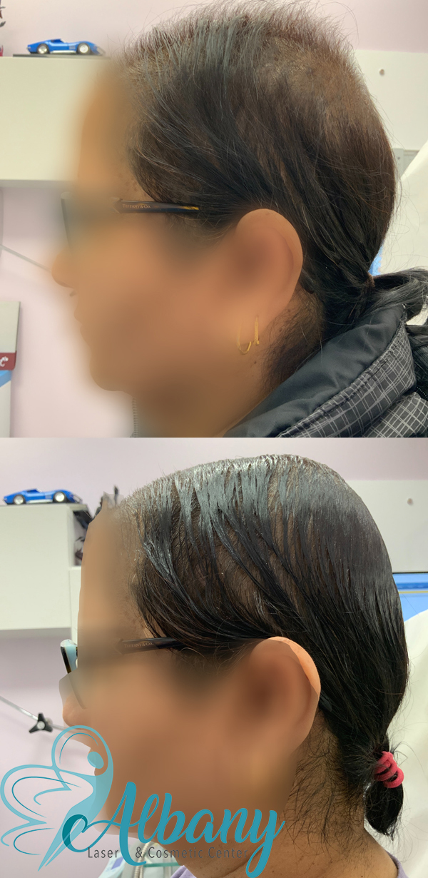 before and after hair loss treatment edmonton