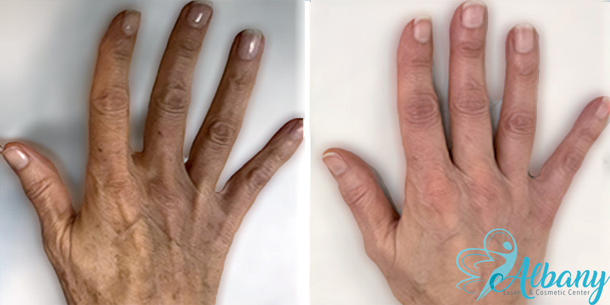 hand-aging-treatment-edmonton