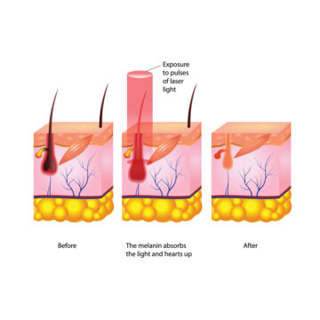 photothermolysis laser hair removal works