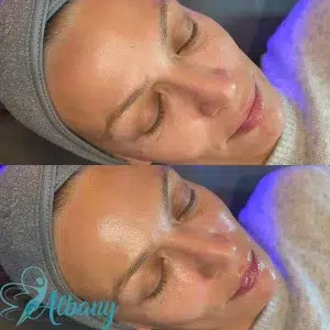 Before and after Hydrafacial improvement in skin texture and clarity of a woman after a HydraFacial treatment.