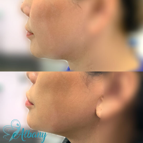 Jaw tightening results