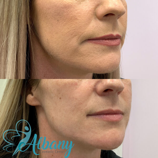 Jawline fillers Results Edmonton