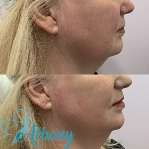 before and after awline contouring with pdo threads