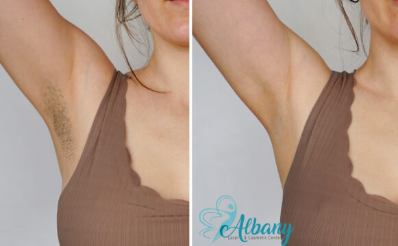 Side-by-side images of a woman's underarm before and after laser demonstrating hair-free, smooth underarm skin