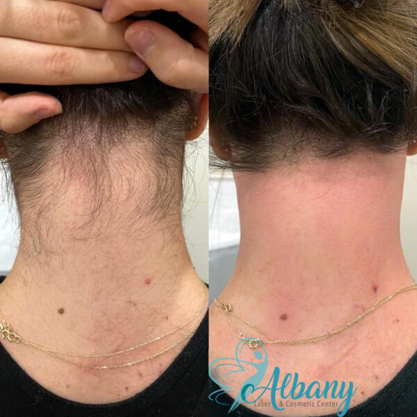 Before and after images of laser hair removal on a white woman's back neck area, showing the removal of hair and resulting in smooth, hair-free skin.