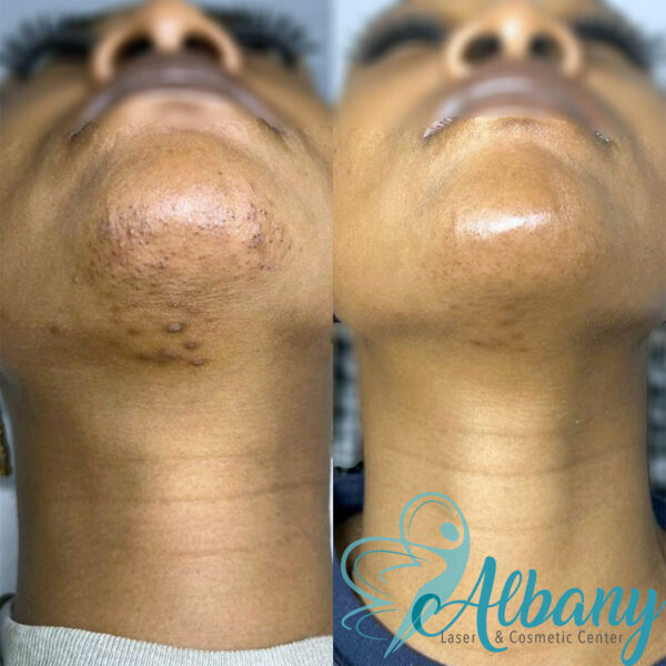 Before and after images of laser hair removal on a dark-skinned woman's chin area, showing a significant reduction in hair, smoother skin, and the elimination of ingrown hairs.